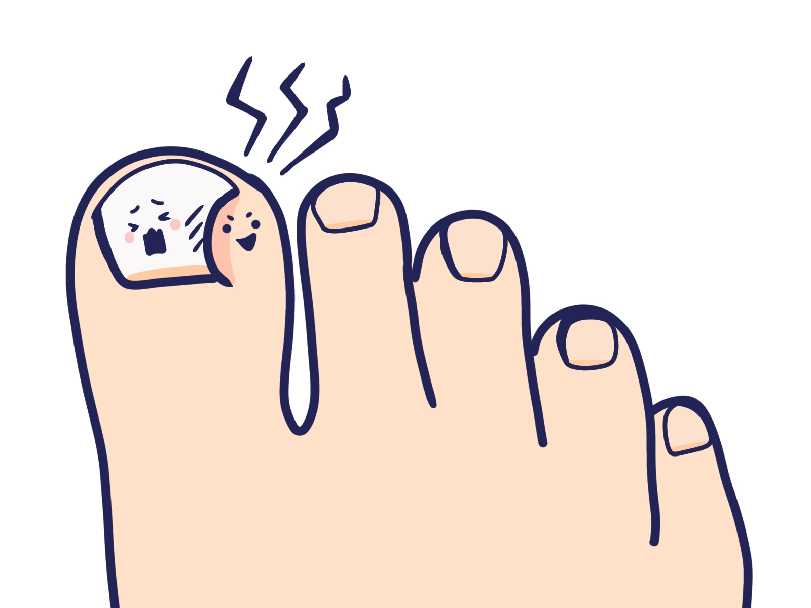 陥入爪の症状イメージ