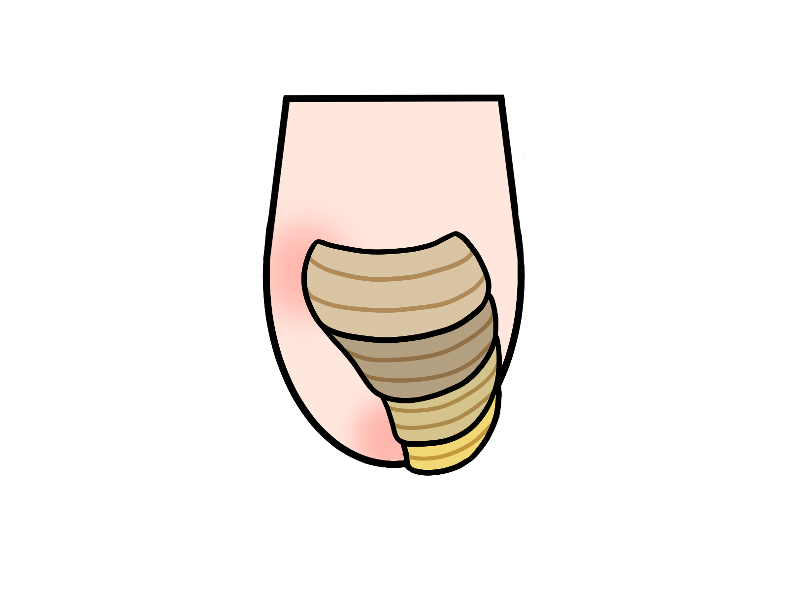 肥厚爪の状態イメージ