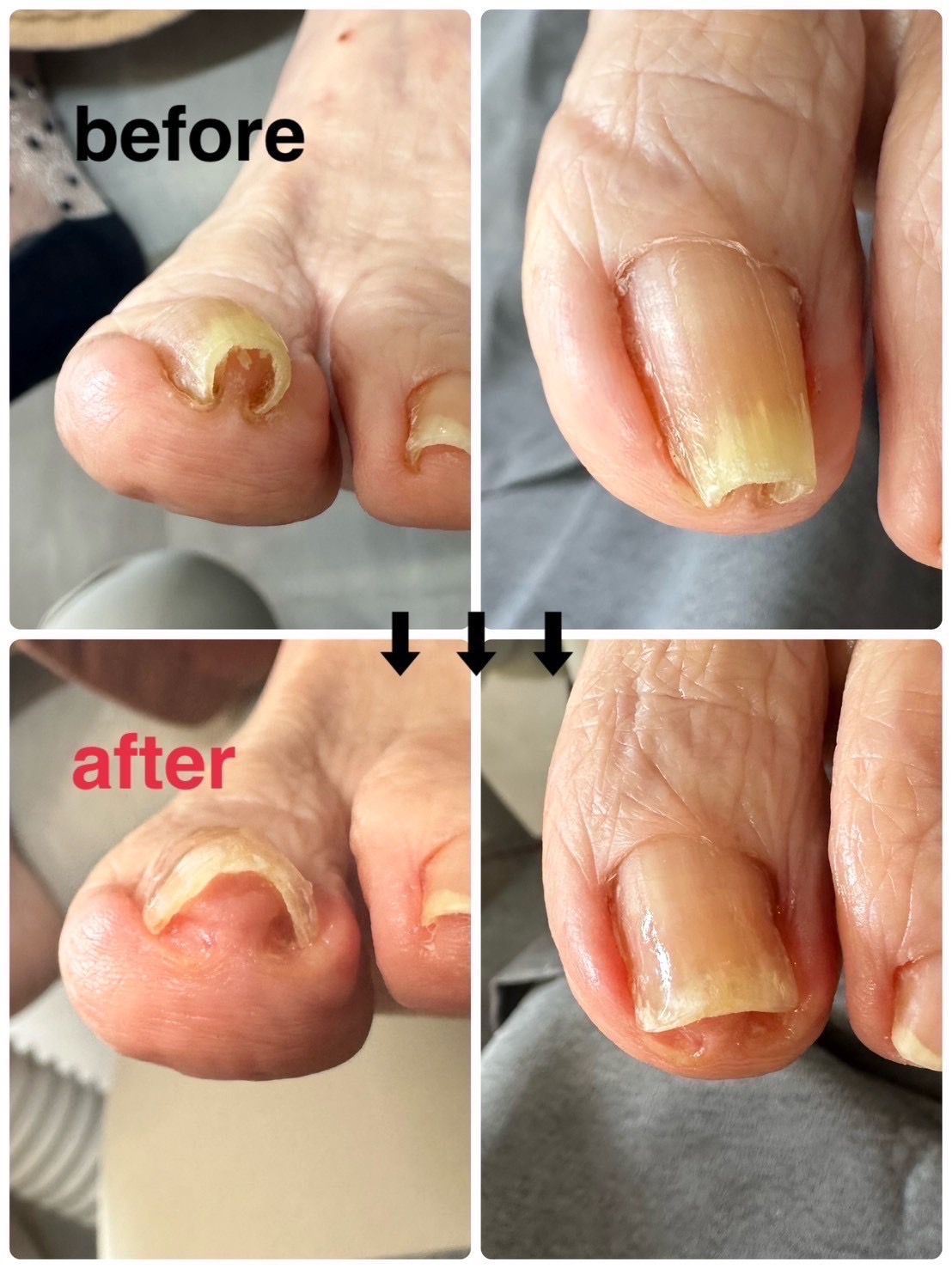 巻き爪補正の施術実績